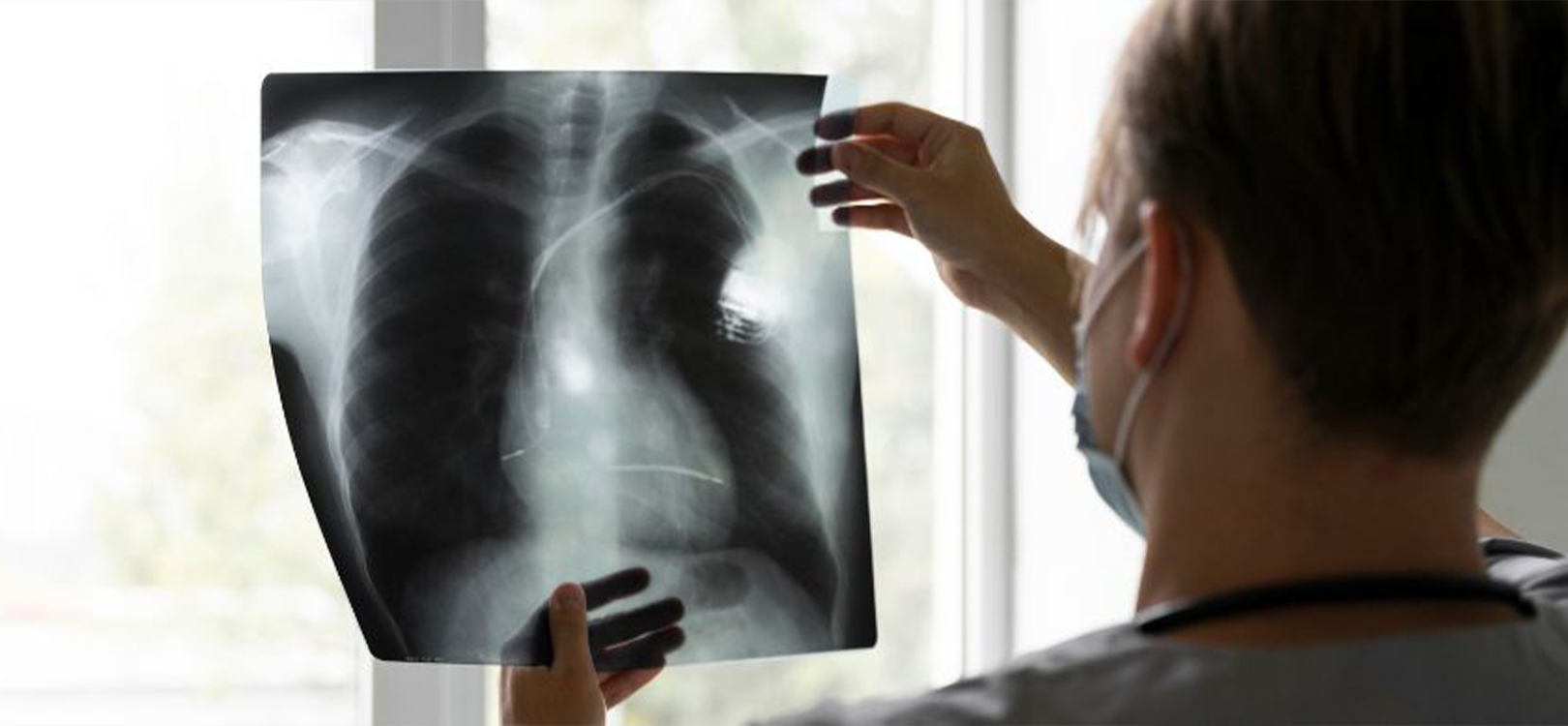 Pneumonia Treatment